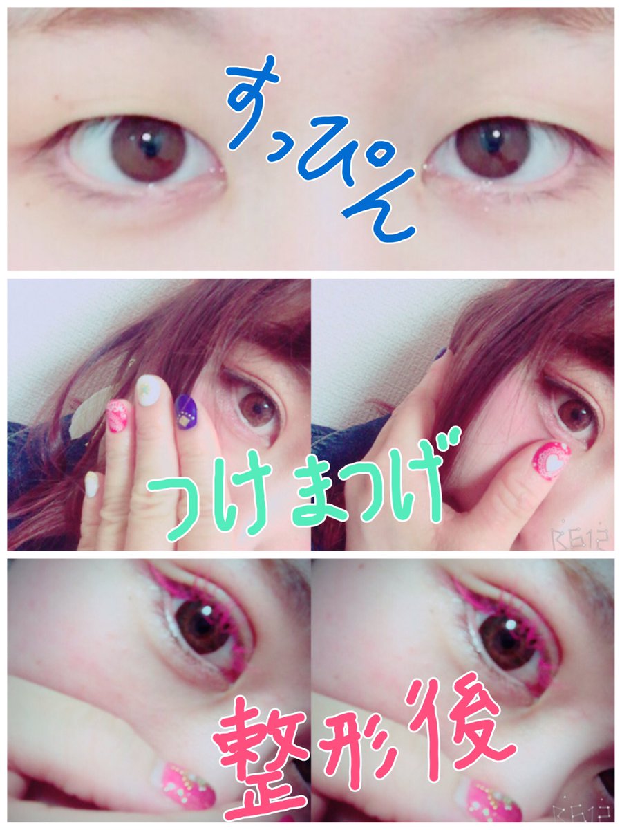 みみみ בטוויטר すっぴん 整形前 つけまつげ 整形前 整形後 整形する前はつけまつけるだけで自然な二重になってたな 整形してからまだぶりぶり二重 前みたいに自然な感じにならんかな むむっ