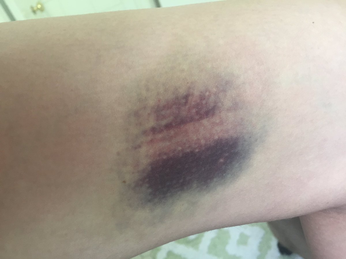 natmatt93's tweet image. Now THAT'S a bruise! #baseball #pitcherproblems #battingpractice