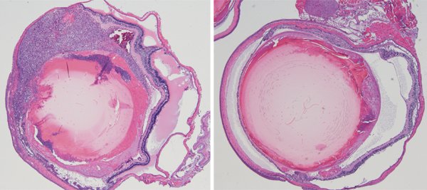 HealthTBN's tweet photo. Uncommon eye illness ... #ARF6 #Cancer #CancerCell #EyeDisease #EyeNeoplasm #news https://t.co/3McXFKCJEC https://t.co/CcEZAGj3Mp