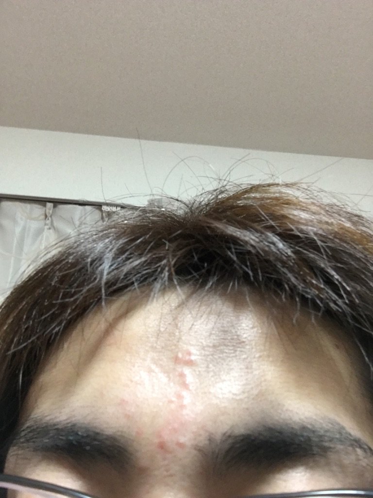 桂三四郎 Sur Twitter でこにできもんでけた かゆいのでウナコーワ塗ってます 足ツボの好転反応ではないと思うけど 桂三四郎 Sur Twitter でこにできもんでけた かゆいのでウナコーワ塗ってます 足ツボの好転反応ではないと思うけど