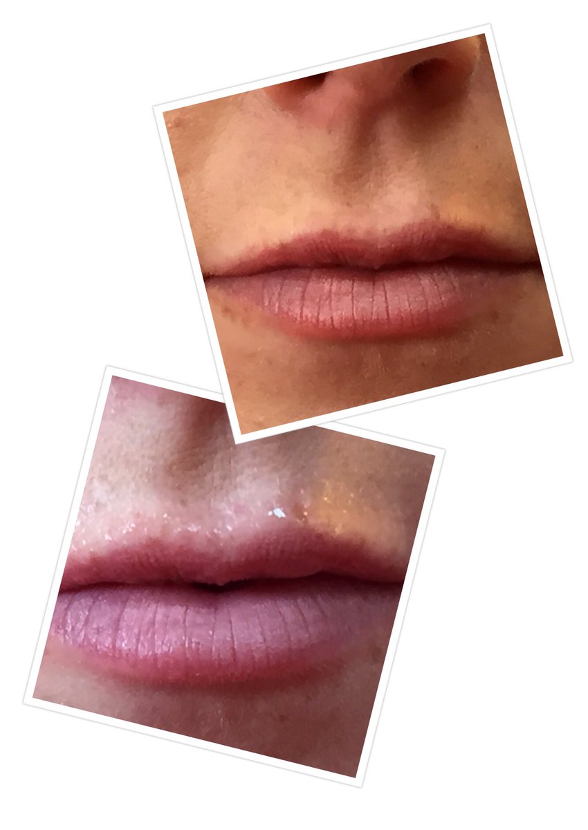 hydrafacial lip perk near me