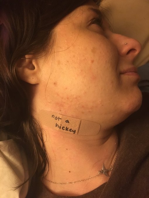 part 2 in a series where my mother hurts herself: a curling iron burn that looks like a hickey https://t