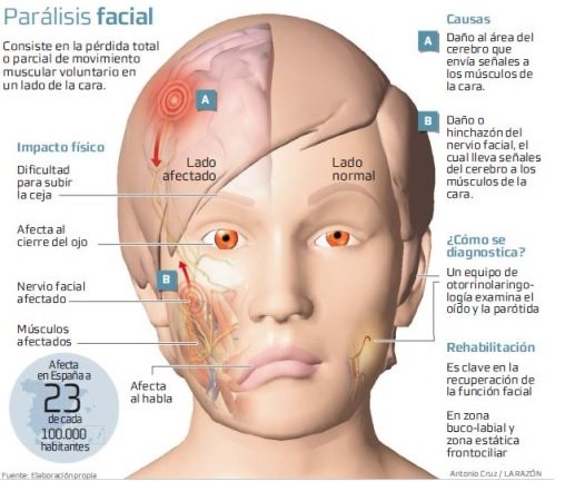 cgcfe's tweet photo. Parálisis facial: La labor del fisioterapeuta fundamental para los pacientes.Vía @larazon_es https://t.co/9BwNFe1OsW https://t.co/FkuYHzySDM