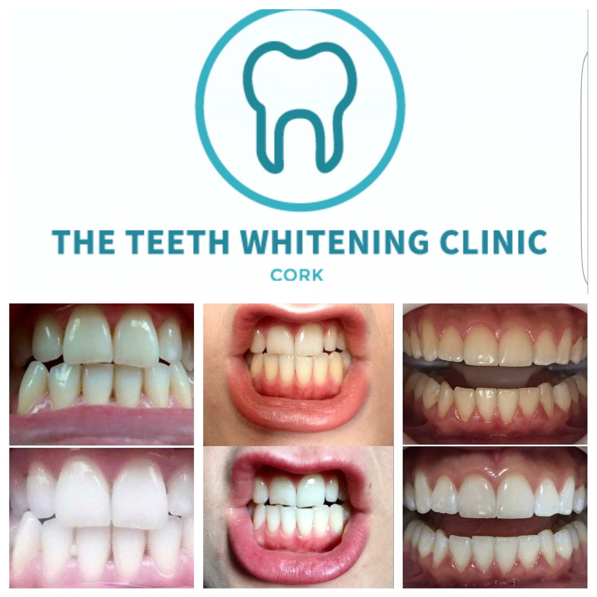 TTWCCork's tweet photo. @ #teethwhiteningcliniccork our #amazing #results are Easy to see. #zerosensitivity #whitesmile #cork #corkcity https://t.co/Wej0qDOLsg