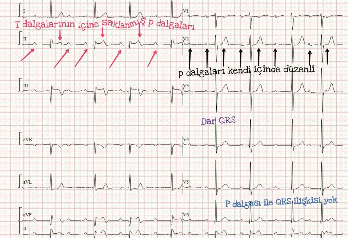 İnferior mi sonrası AV blok.p dalgası QRS ilişkisi yok. Hastanın RCA sina stent konuldu.kalp hızı yeterli.