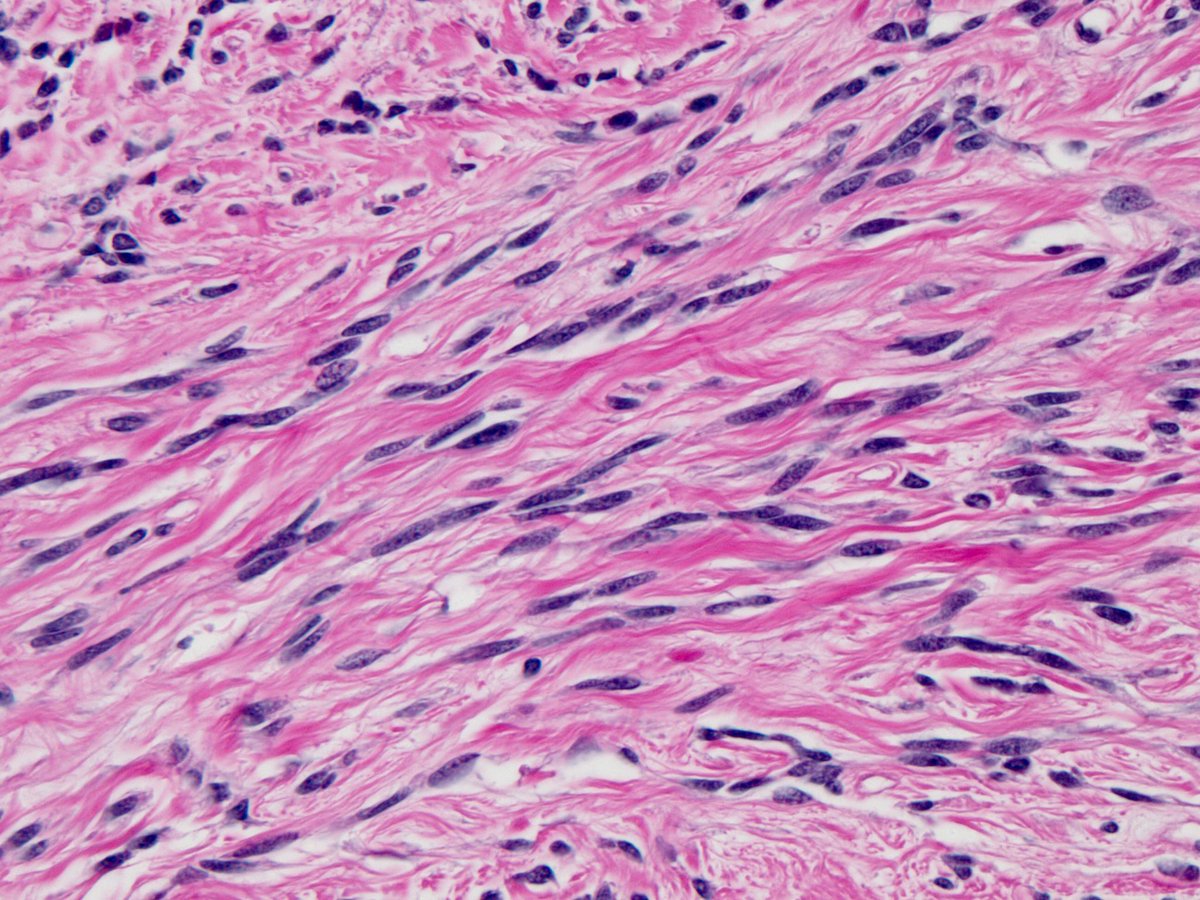 smlungpathguy's tweet photo. Guess the IHC #pulmpath #pathboards @marenwhymd @marcoslepe @mannanrifat03 @pembeoltulu @rehdam @KyleBradleyMD https://t.co/b3vq6dhKOl