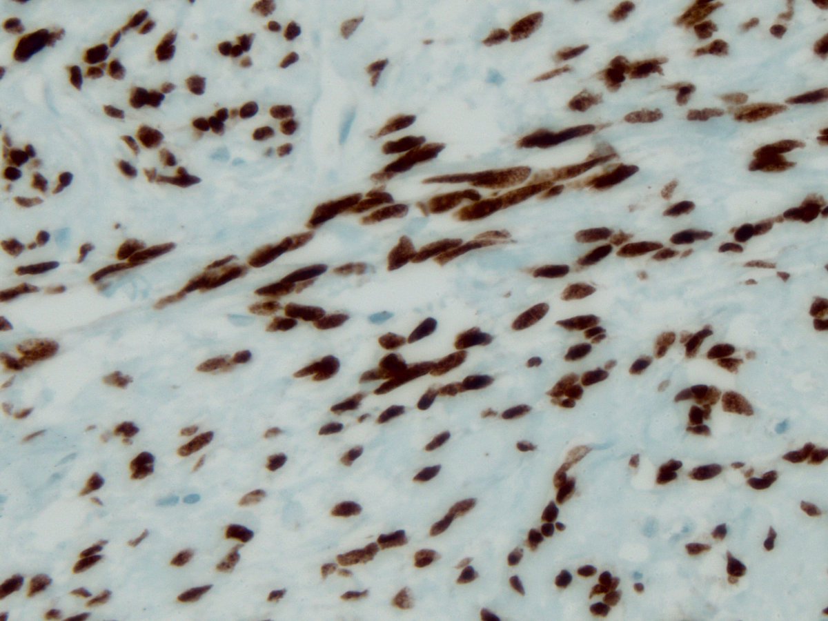 smlungpathguy's tweet photo. Guess the IHC #pulmpath #pathboards @marenwhymd @marcoslepe @mannanrifat03 @pembeoltulu @rehdam @KyleBradleyMD https://t.co/b3vq6dhKOl