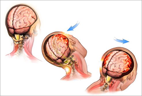 neuropractice's tweet photo. How Does Neurofeedback Treat Concussions? https://t.co/zUZWRwtAW9 #concussions https://t.co/39Gt6XmorU
