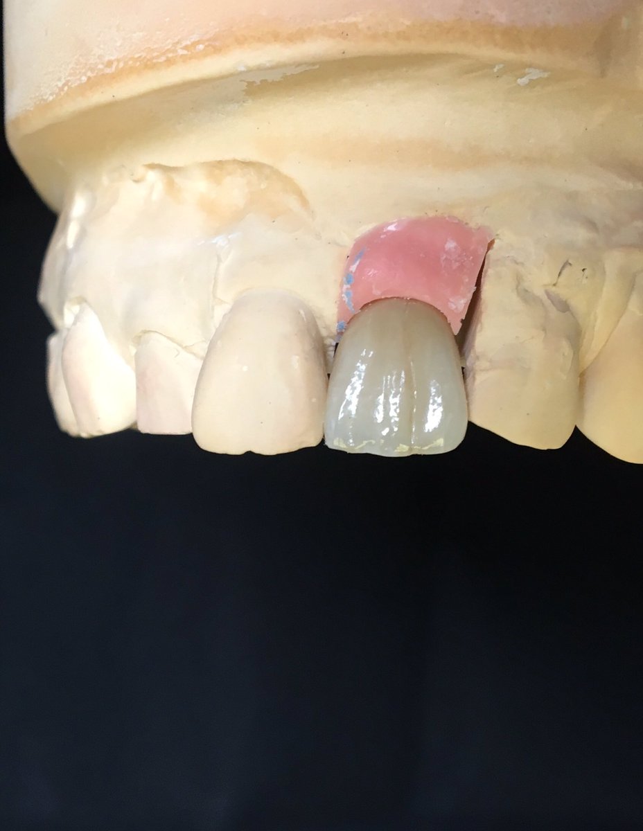 DSDdentallab's tweet photo. Tricky shade! But great results on this screw retained crown! #implant #straumann #digitalworkflow https://t.co/gk0F4Hbr1r