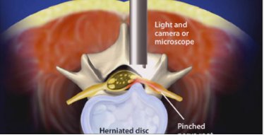 NJ_SPINE's tweet photo. Having pain due to disc herniation? #MinimallyInvasiveDiscectomy may be an option.
https://t.co/9heSsD9IE3 https://t.co/rx7U5ARlz4