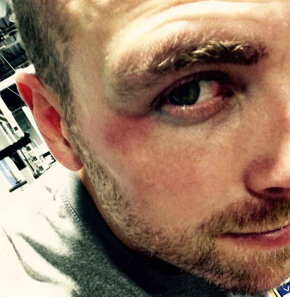 LeeTortorelli's tweet photo. Shout out to @winterton_brock and Hunter Bowen for giving me the goose egg and black eye You guys are tuff! #punched https://t.co/2IzXPGUwpE