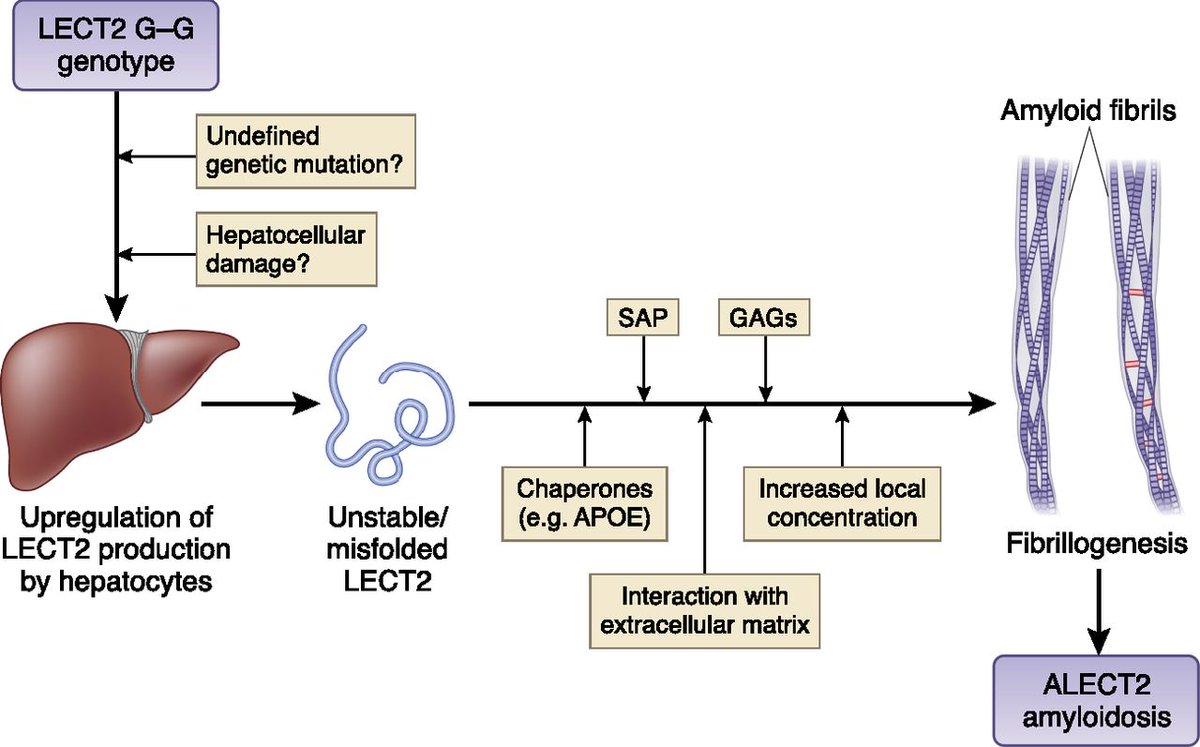 ALect2A's tweet photo. The etiology of LECT2 #amyloidosis is a mystery. Here is a nice summary of what is known. https://t.co/hbJDEs9eIz https://t.co/mXlt779drO