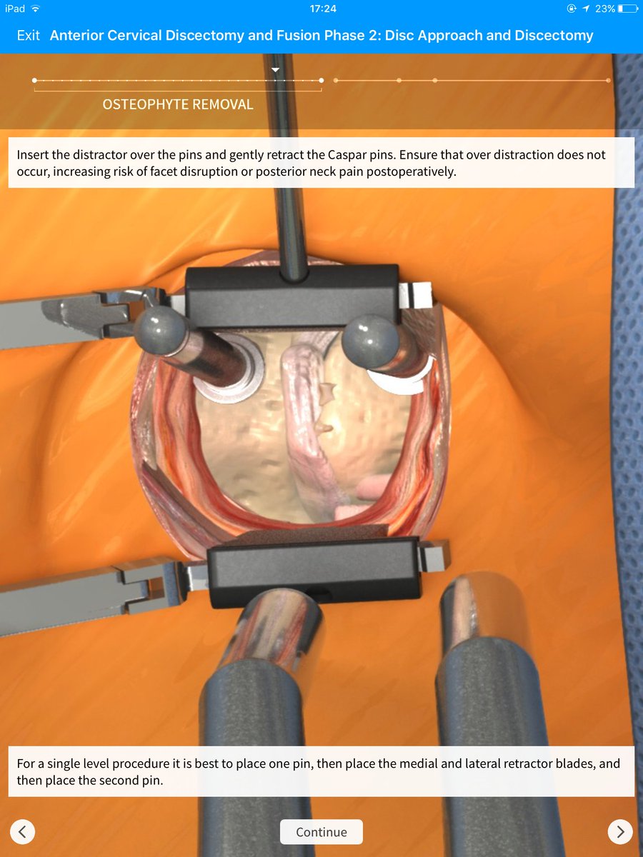 TouchSurgery's tweet photo. ACDF is one of the most common #neurosurgical and spine #orthopedic procedures performed https://t.co/nCpiosNGuI https://t.co/xXuN5xs6Lm