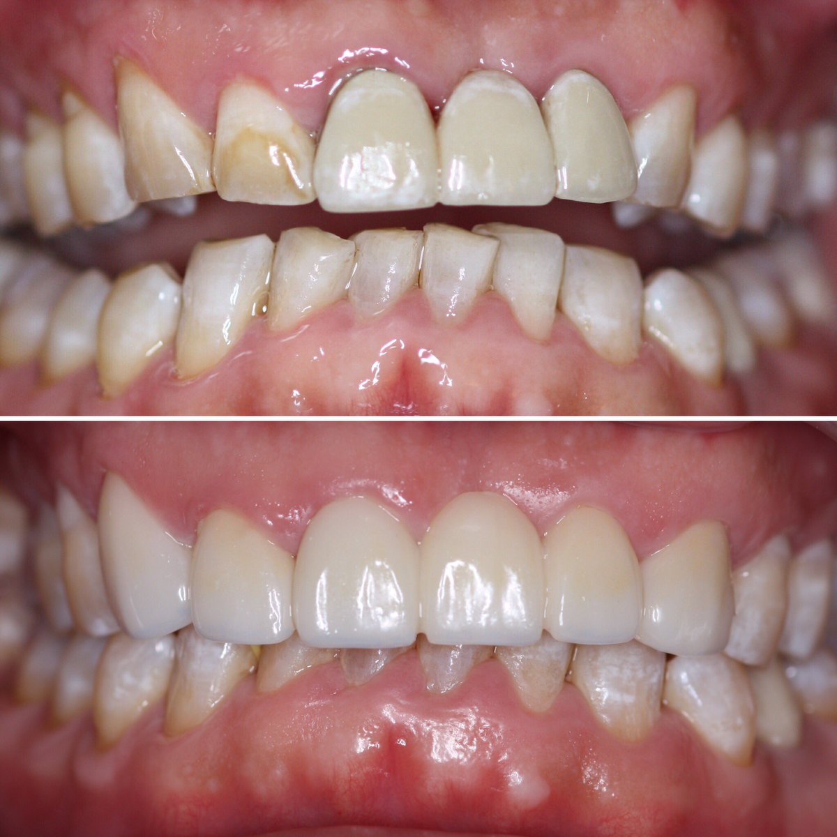 drandrewjkeller's tweet photo. Porcelain bridge/veneers. #veneers #bellevue #dentist #bellevuedentist #davincidental https://t.co/jKUCKZSd5K https://t.co/1jKnD0Jkac