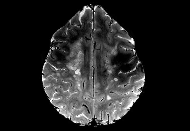 parkinsons disease oxford american neurology library