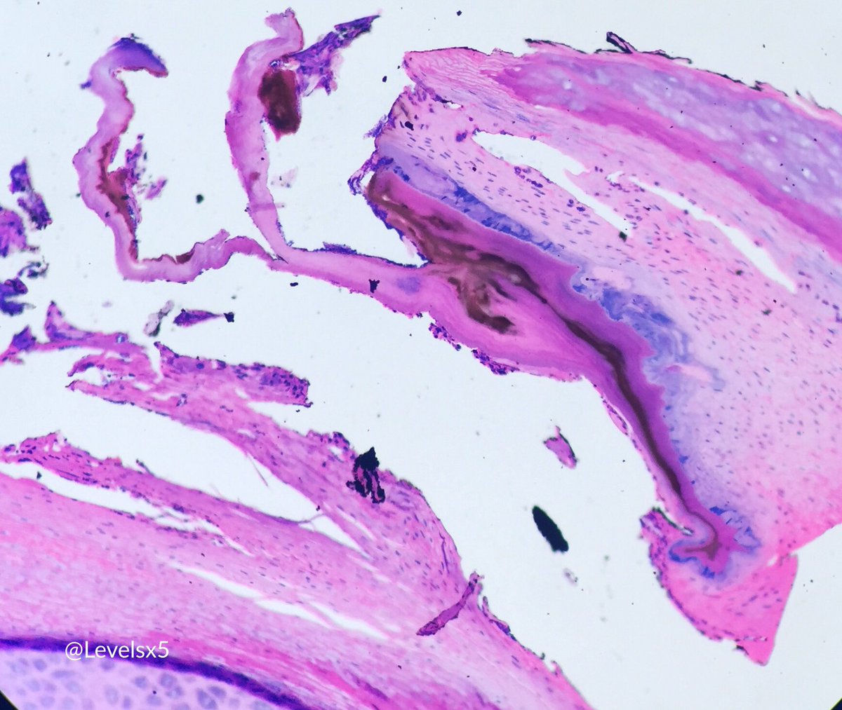 Levelsx5's tweet photo. Tungiasis w/ chigoe flea remnant (Stage 4?) embedded in stratum corneum #bugpath #dermpath #BrownPathology https://t.co/u6maAETXUe