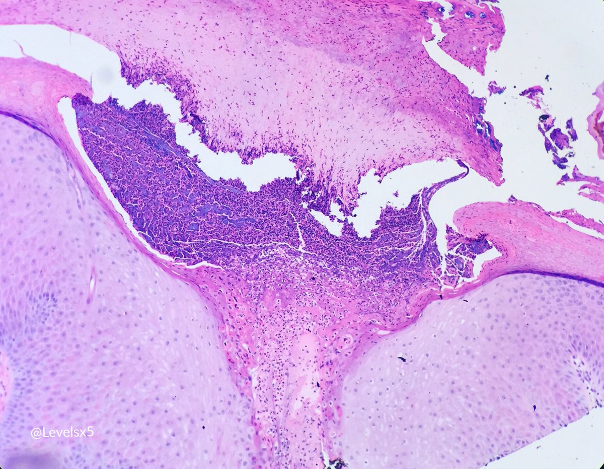 Levelsx5's tweet photo. Tungiasis w/ chigoe flea remnant (Stage 4?) embedded in stratum corneum #bugpath #dermpath #BrownPathology https://t.co/u6maAETXUe