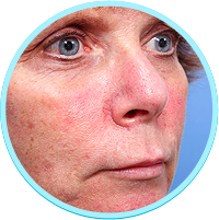 Begin your anti-redness cream #RiskFreeTrial today. You’ll see amazing results in no time at all!