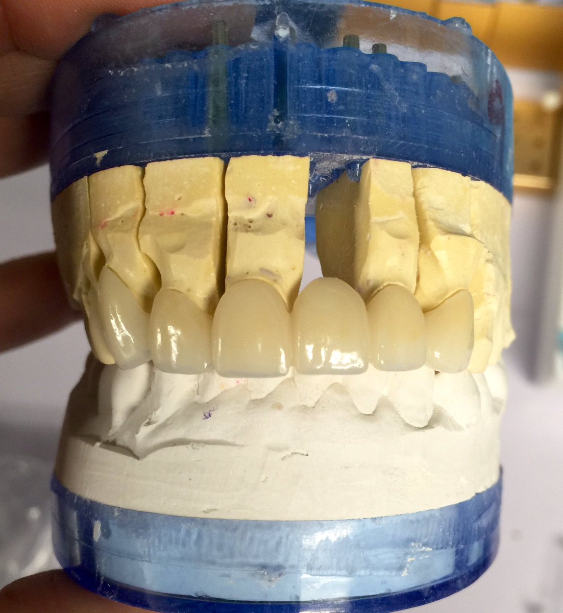 drandrewjkeller's tweet photo. Porcelain veneers and bridge Dr. Andrew Keller. #bellevue #dentist #veneers #implant #missingtooth #smile https://t.co/ldgv5VmaGd