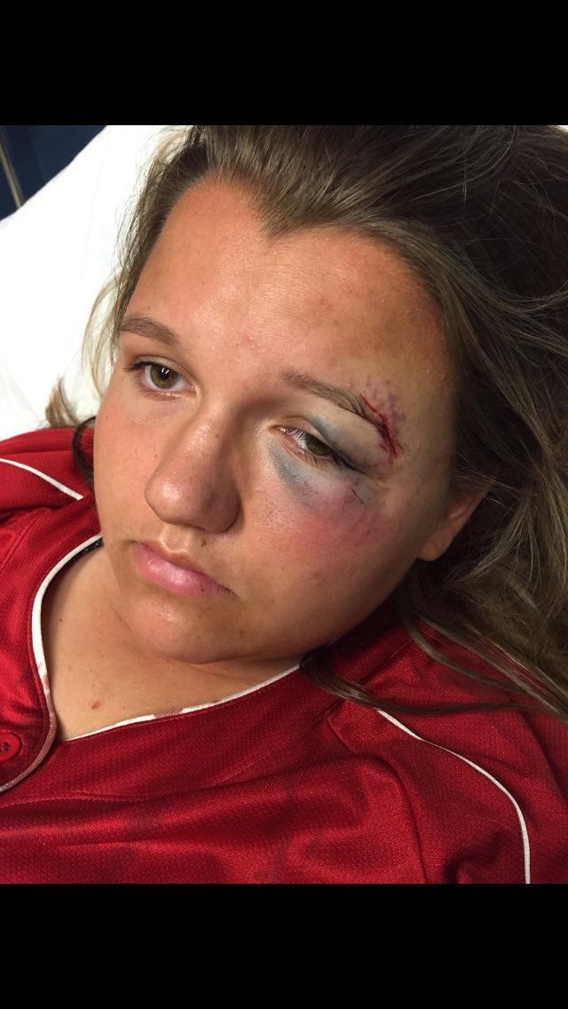 quinny_00's tweet photo. it's not an easy sport I tell ya #12stitches https://t.co/kv2gZuTajk