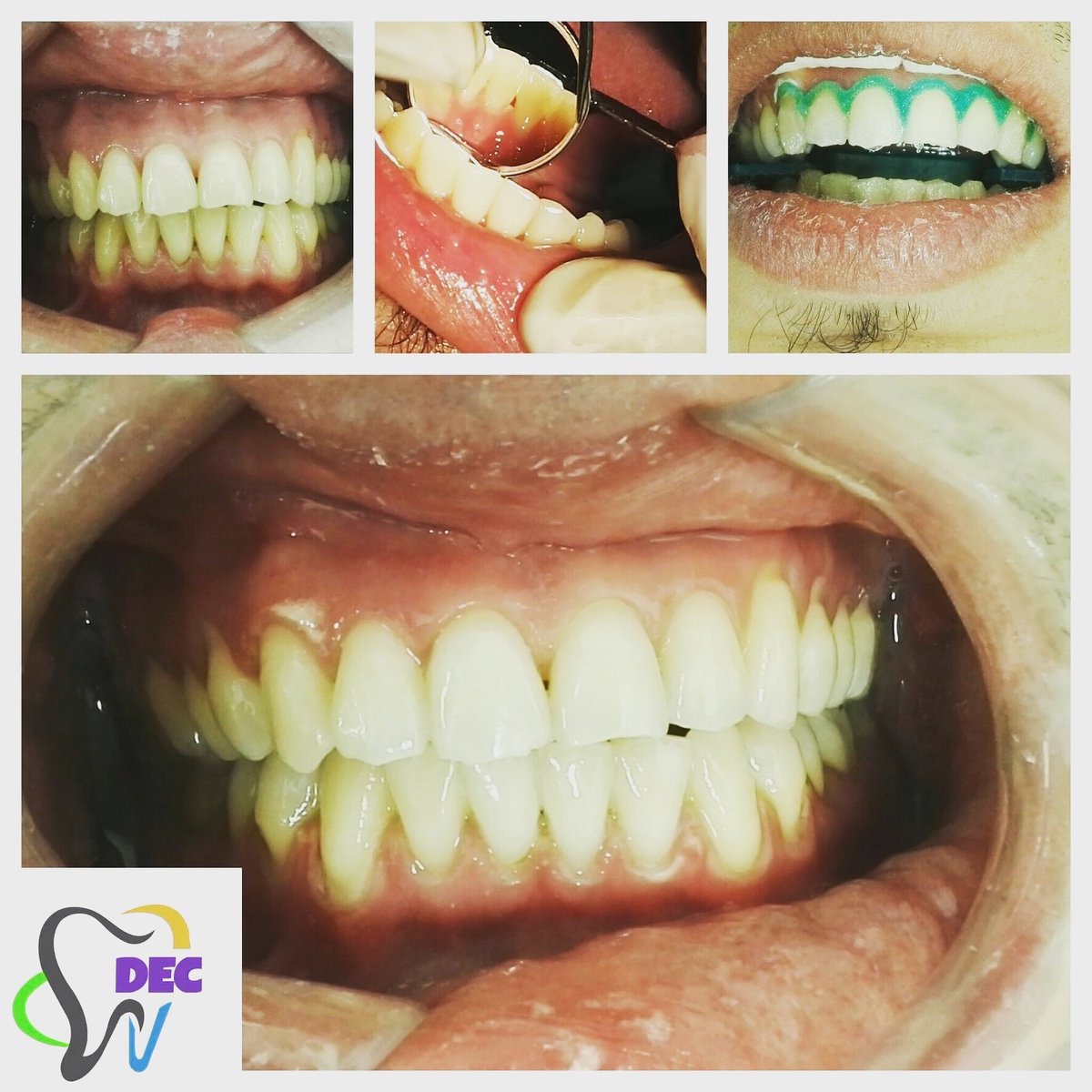 Blanqueamiento paso a paso!! Comunicate al numero 32414252