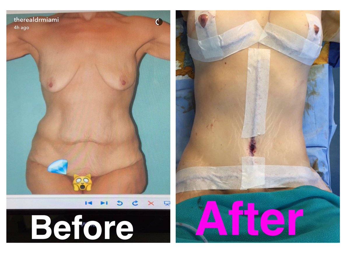 Gurly4God's tweet photo. Best Transform @TheRealDrMiami #tummytuckvert/horiz #breastaug, sc @therealdrmiami #flab2fab👌🏼 https://t.co/xnlax4Ek0x