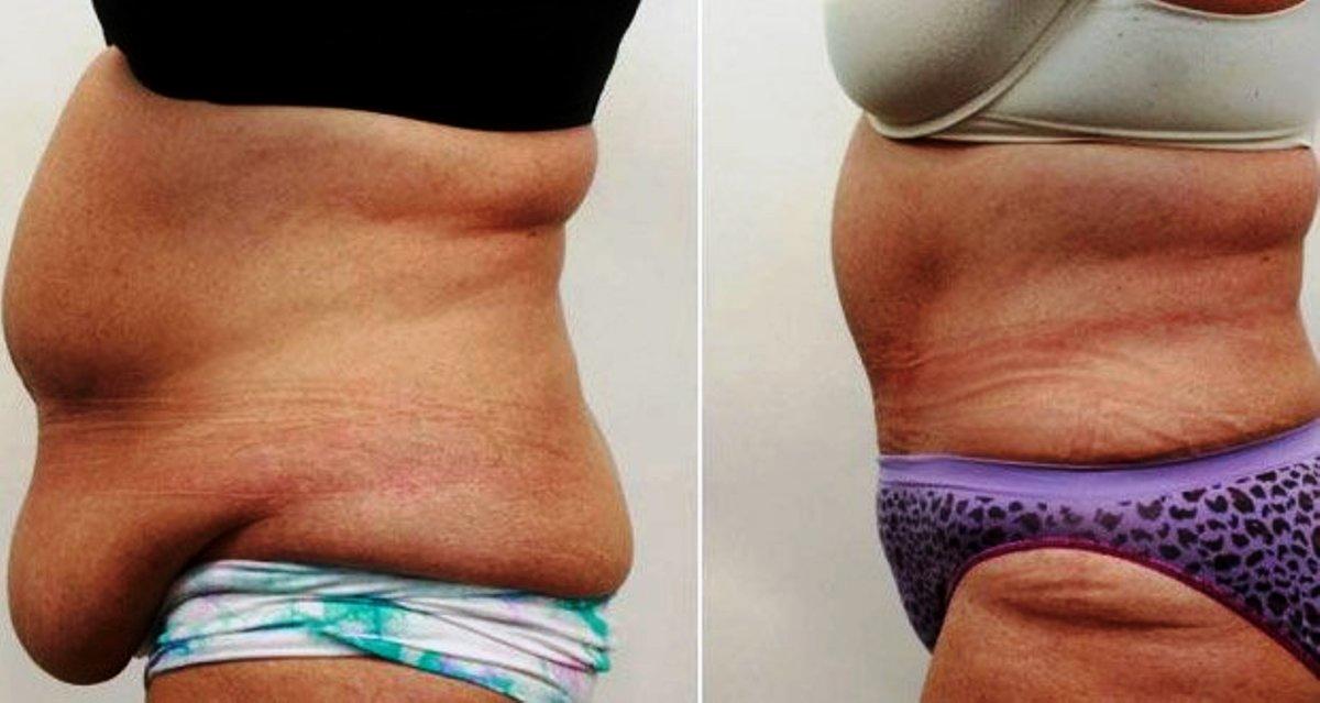 wayne_rita's tweet image. 🏻 New Controversial 'Skinny Pill' Targets Your Mid-Section - bit.ly/1WhHkuX