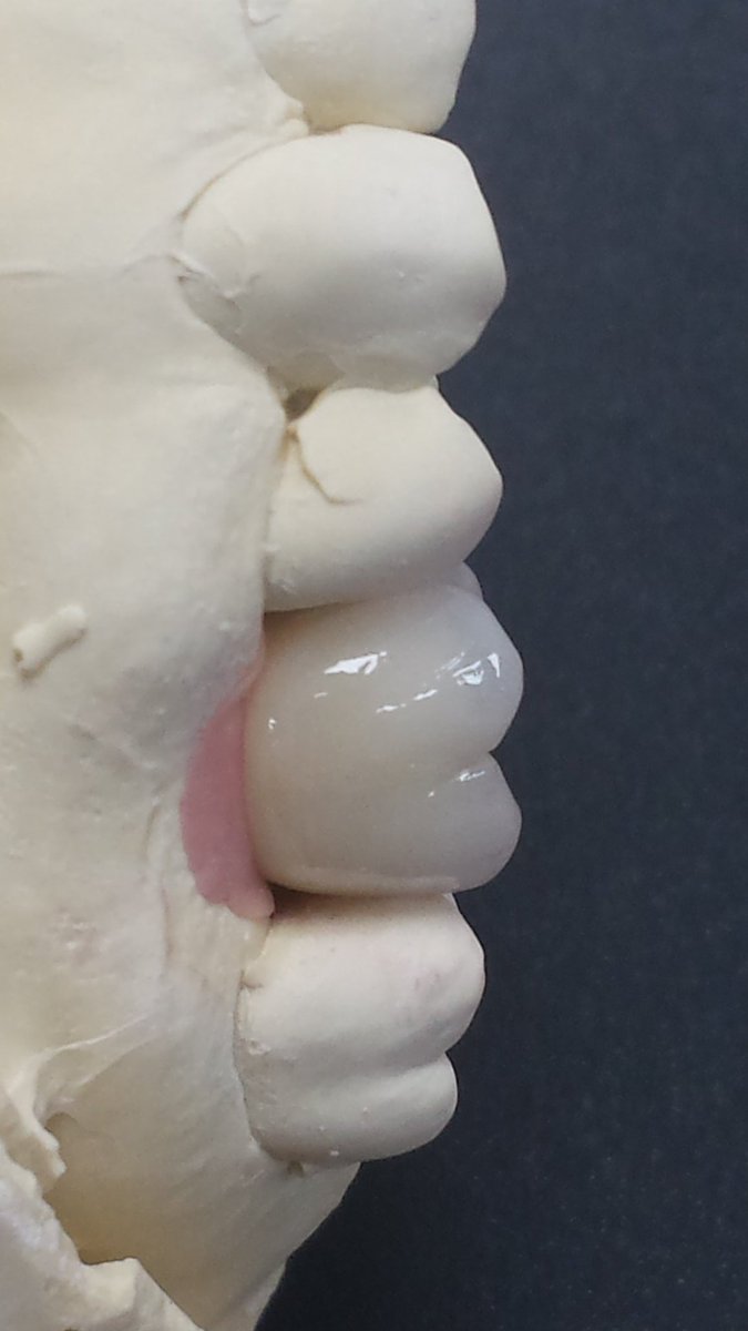 joselumelgar's tweet photo. Screw retained crown , #southernimplants #ivoclar #IPSInLine https://t.co/juaiOuJVV4