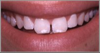 BittnerSmiles's tweet photo. Your #dentist can reshape your teeth, #closespaces, restore worn or short teeth or alter the length of your teeth. https://t.co/kZw7264hiu