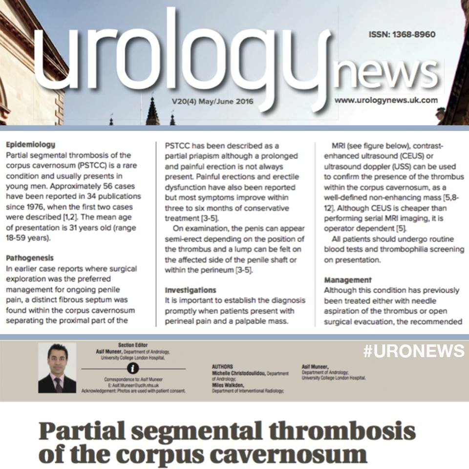 Uro_News's tweet image. Most patients maintain their #erectilefunction without the need for #PDE5i bit.ly/1U85hio #uronews