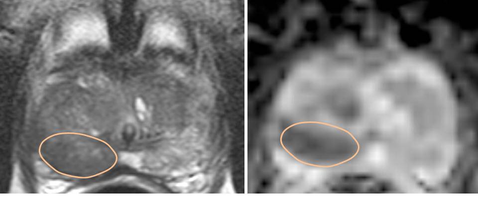 Gio_Pini_'s tweet image. Discrepancy between #PIRADS4/5 #multiparametric#MRI and #prostate #FusionBiopsy: #prostatitis @Uroweb @EAUYAUrology