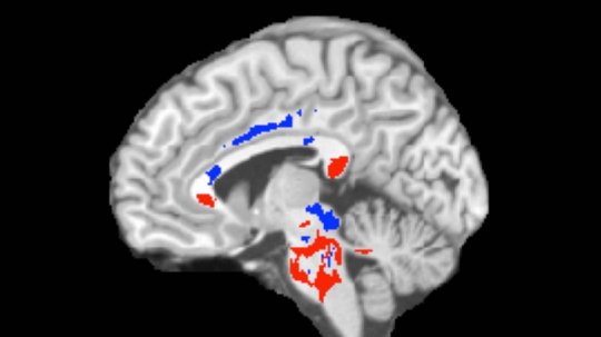 HarperUnbound's tweet photo. Concussion outcome predicted using advanced imaging: 
https://t.co/gwsRMKJ0oJ https://t.co/PsejsG66zo