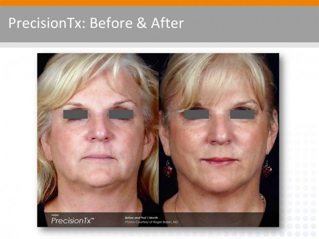 CynosureEMEA's tweet photo. Before and after #PrecisionTx the results on the lower face and neck continue to improve over time https://t.co/iuzjOeDVez