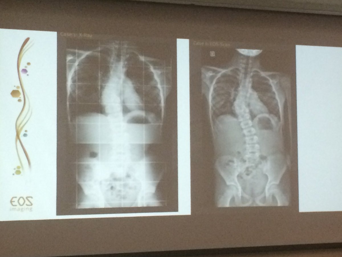 Only 8 EOS Imaging machines in Canada! At Stollery,~800 kids have already used the new machine.#TheDonorDifference!