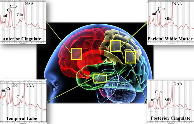 HamOntReporter's tweet image. Brain Scans to Distinguish Between Brain Injury and PTSD: 
spectrum.ieee.org/the-human-os/b…