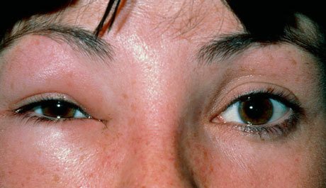 PULSE365_Hub's tweet image. Our new #freemodule offers advice on managing patients with #allergy to wasp/bee sting bit.ly/1S3yHfi