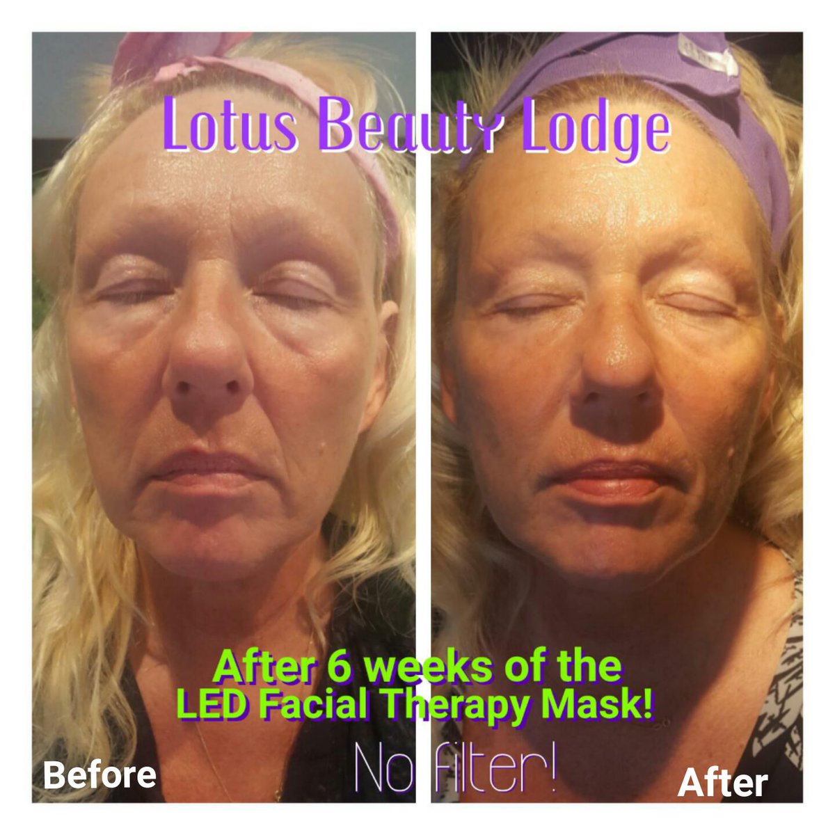 LotusBeauTLodge's tweet photo. 1 very happy lady!! Amazing results in just 6 sessions of #diamondmicrodermabrasion & the #ledtherapymask 💜 https://t.co/pVCVBSwM7U