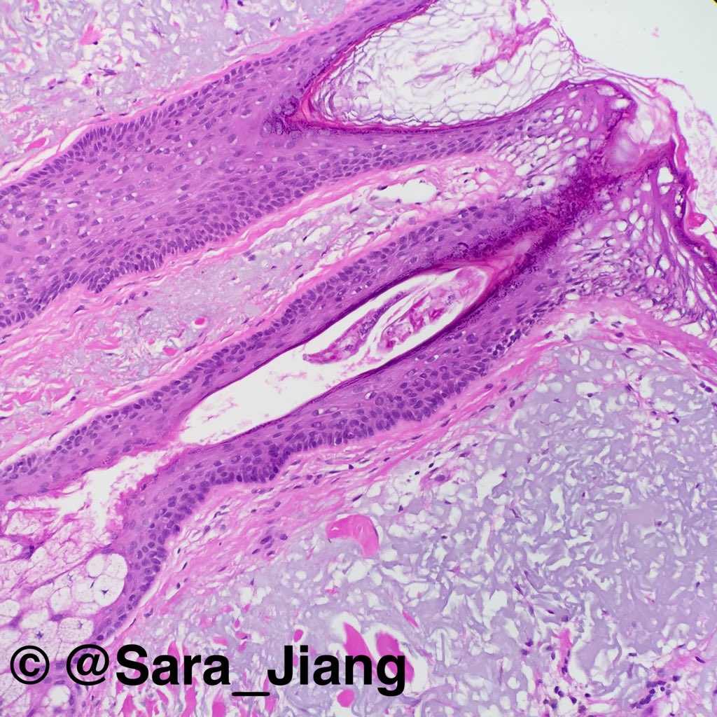 Sara_Jiang's tweet photo. Your face is full of mites living in pores &amp; eating skin cells! They crawl out @ night. Meet Demodex!You're welcome! https://t.co/RGIdDVfiF6