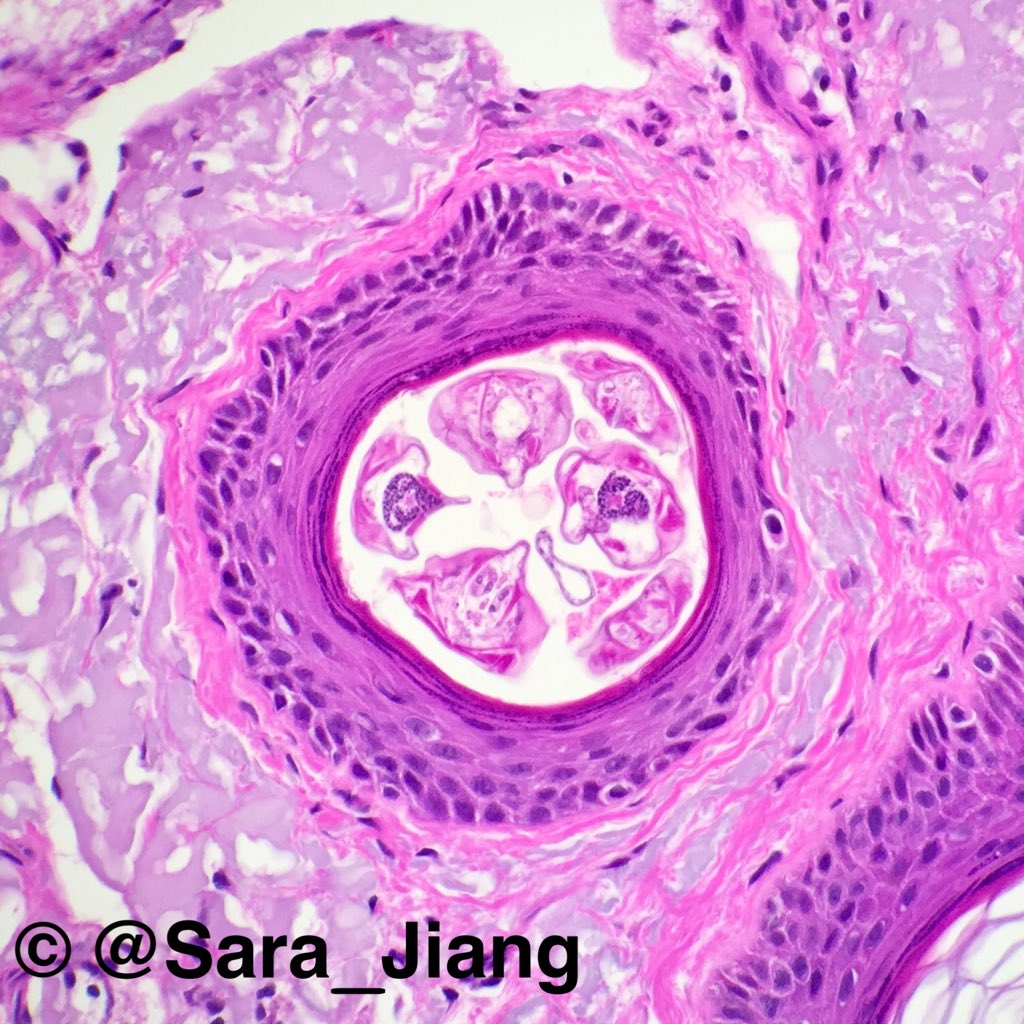 Sara_Jiang's tweet photo. Your face is full of mites living in pores &amp; eating skin cells! They crawl out @ night. Meet Demodex!You're welcome! https://t.co/RGIdDVfiF6