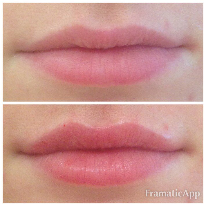 Lip filler is designed to plump and reshape lip contours &amp; increase lip volume #lips💋