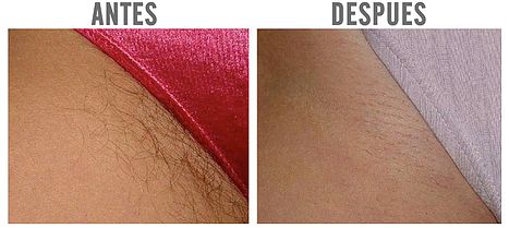 Depilacion del area del bikini Depilacion del area del bikini remarkable
