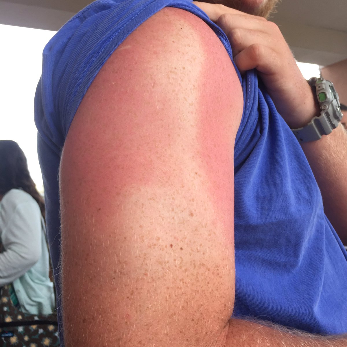 lindseyd03's tweet photo. #askjamantha his sunburn looks like a giraffe can you help? #SLOrangebeach3 https://t.co/X35NsDgYOc
