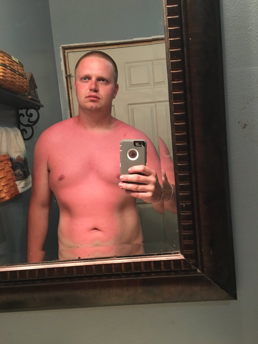 brice_leffler's tweet photo. Put this tanning oil on she said it will help your farmers tan more like burn my whole body! https://t.co/j78akuLf72