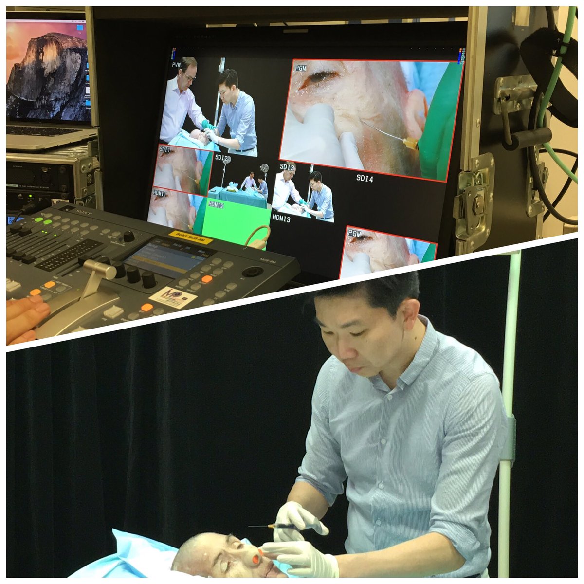 Dr Kieren Bong (@essencemedical) on Twitter photo In Malaysia for Asian <a href="/Teoxane/">Teoxane Laboratories</a> Expert Day. Pre-event filming of advanced filler techniques on cadaver. Impressive! In Malaysia for Asian <a href="/Teoxane/">Teoxane Laboratories</a> Expert Day. Pre-event filming of advanced filler techniques on cadaver. Impressive!