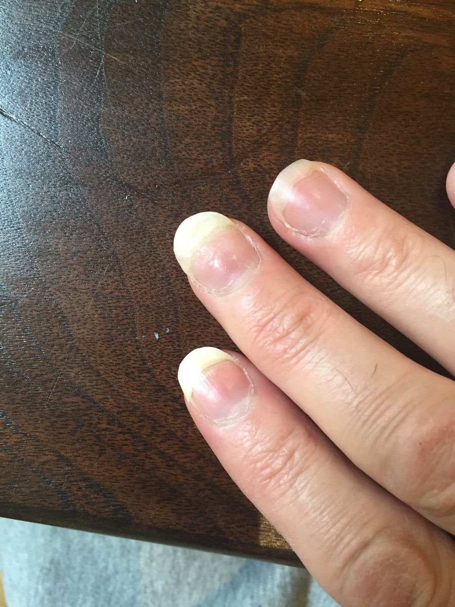 Do I have Terry's Nails? : r/AskDocs