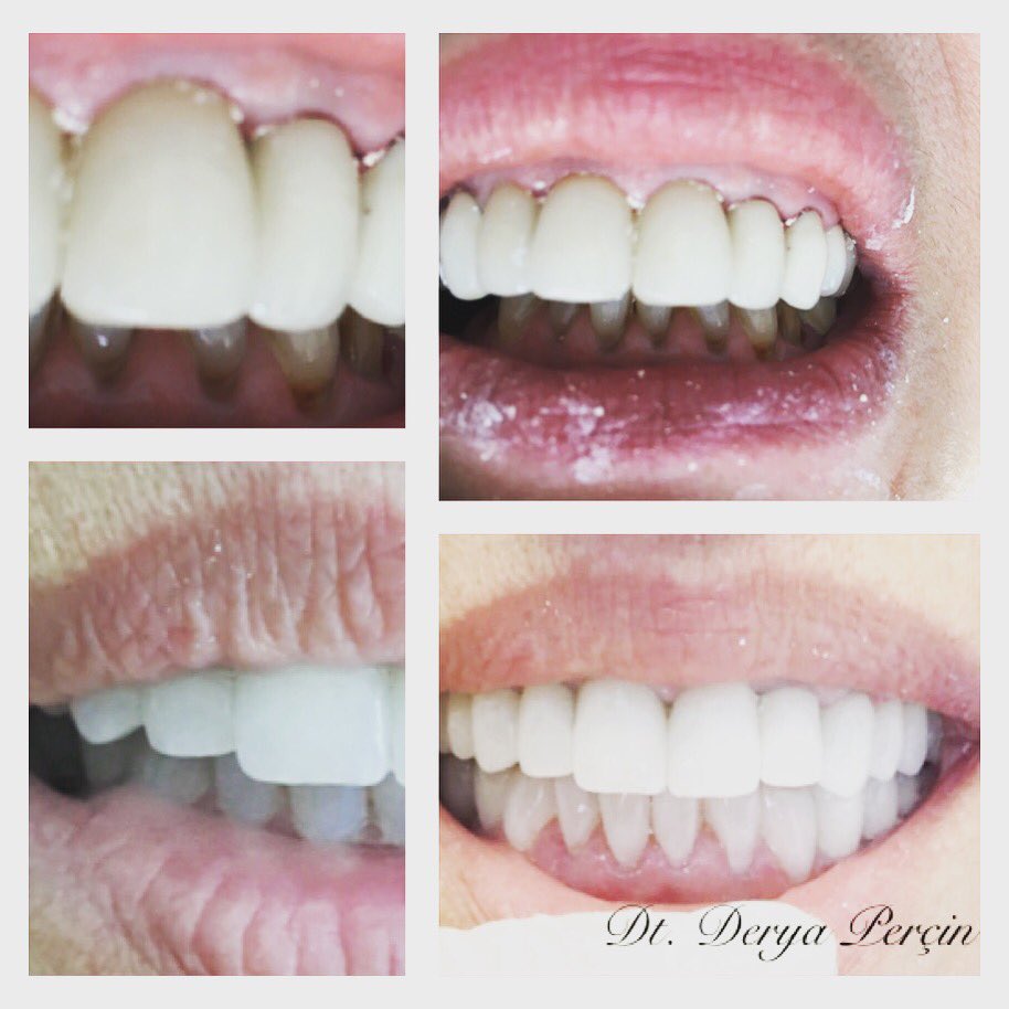 #beforeandafter #dentist #beyazdiş #zirkonyum #porselen #smile #dtderyaperçin #dentist #estheticdentistry