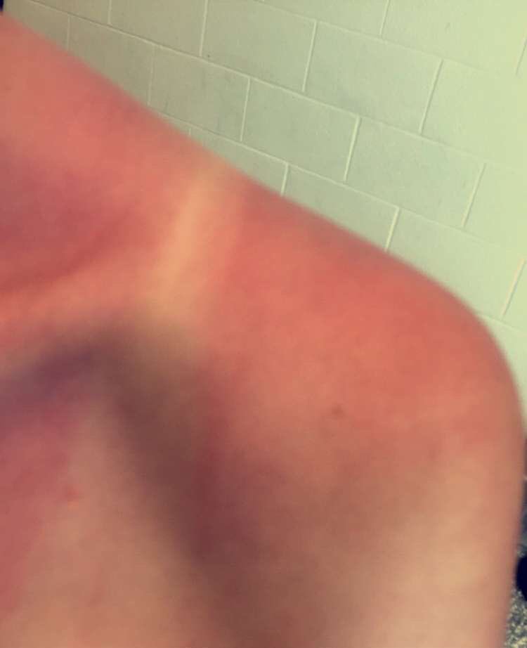 dana_lawless11's tweet image. I used so much sunscreen yet the sun still destroyed me #RelayForLife #lancersagainstcancer