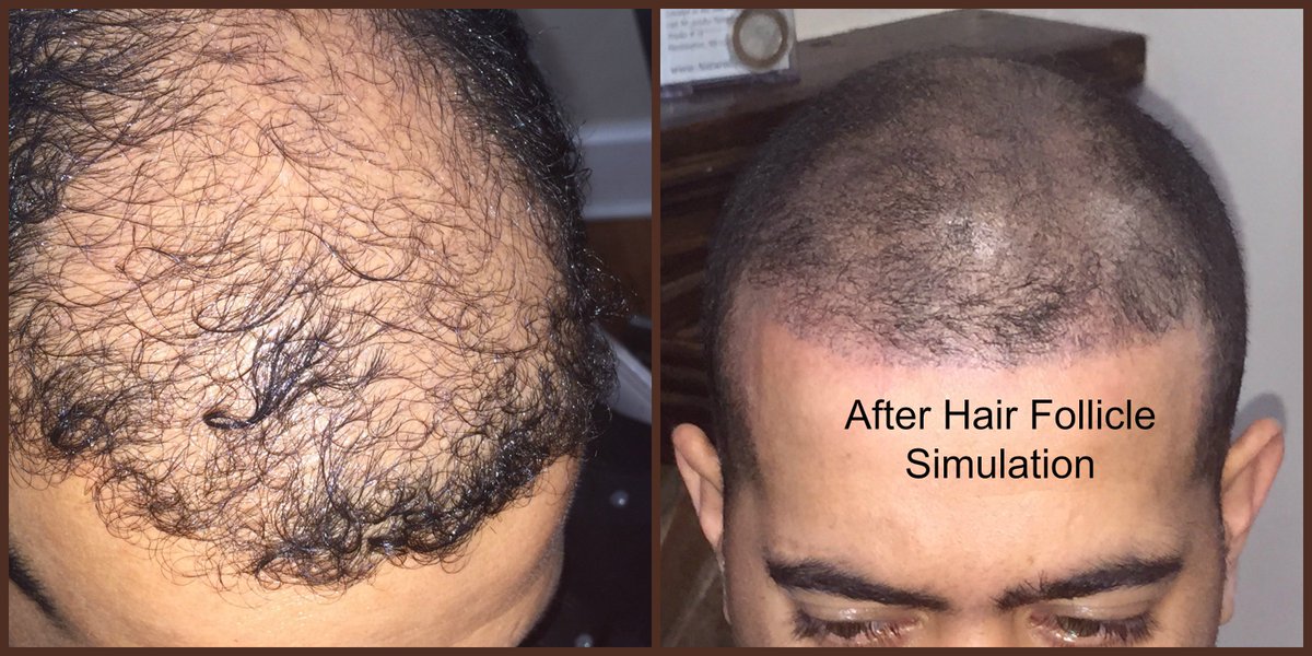 Hairfolliclesimulation Hashtag On Twitter