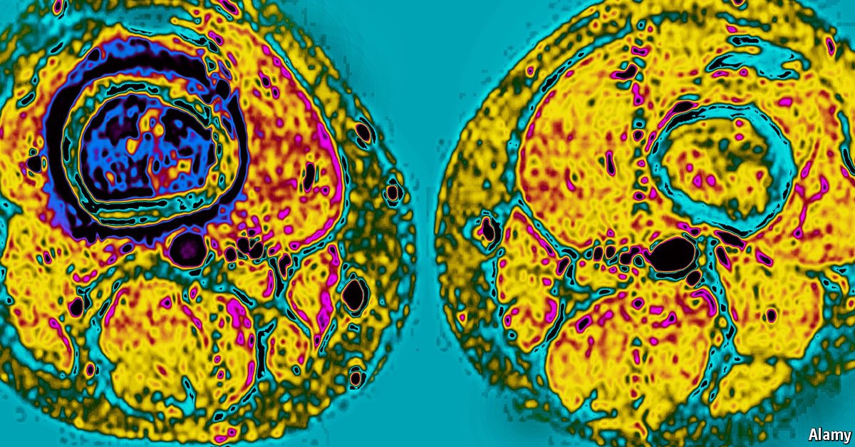 TheEconomist's tweet image. The personalisation of cancer treatments is leading to better outcomes for patients econ.st/25DrHj4