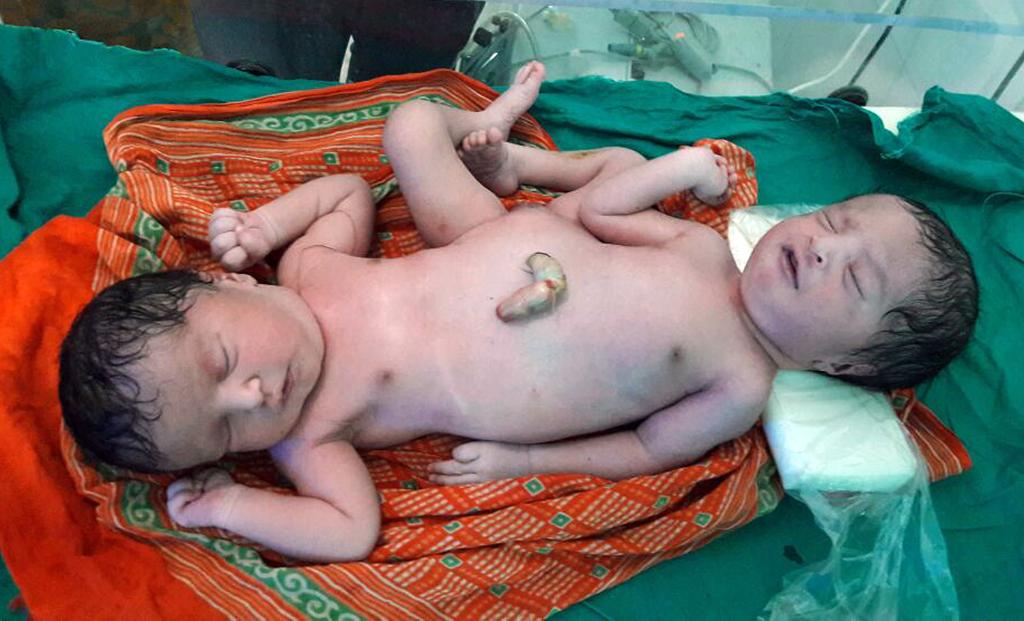 Indian mother gives birth to conjoined twins sharing nearly every organ. pi...